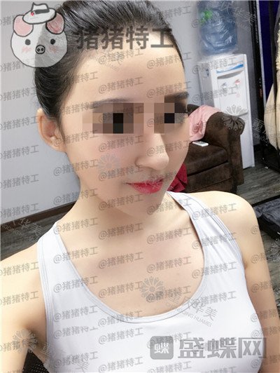 重庆华美,潘宝华,颧骨整形,案例,价格,