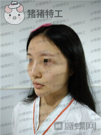 上海九院,李茂群,隆鼻,案例,价格,