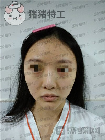上海九院,李茂群,隆鼻,案例,价格,
