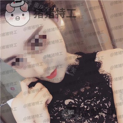 重庆华美,潘宝华,颧骨整形,案例,价格,