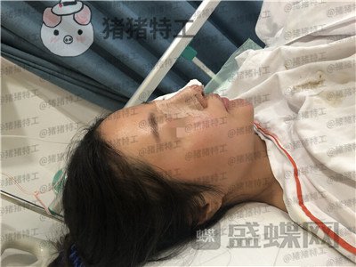 上海九院,李茂群,隆鼻,案例,价格,