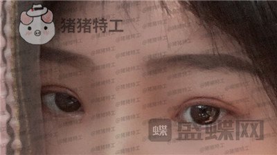 西安高一生,刘军,双眼皮,案例,价格,