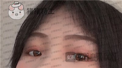 西安高一生,刘军,双眼皮,案例,价格,