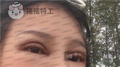 西安高一生,刘军,双眼皮,案例,价格,