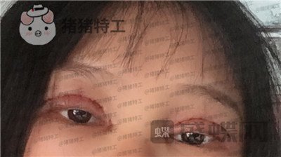西安高一生,刘军,双眼皮,案例,价格,