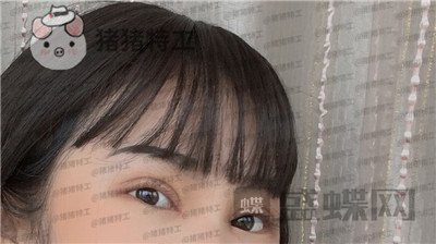 西安高一生,刘军,双眼皮,案例,价格,