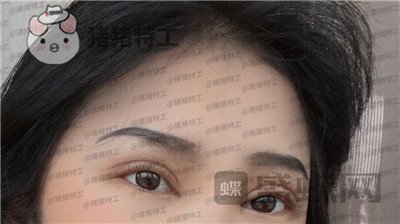 西安高一生,刘军,双眼皮,案例,价格,