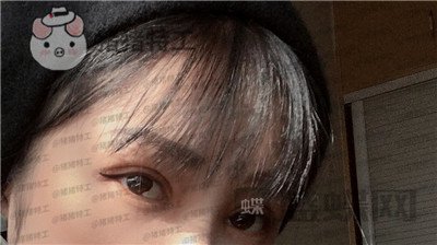 西安高一生,刘军,双眼皮,案例,价格,