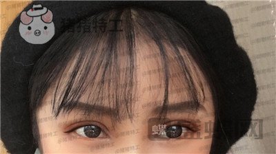 西安高一生,刘军,双眼皮,案例,价格,