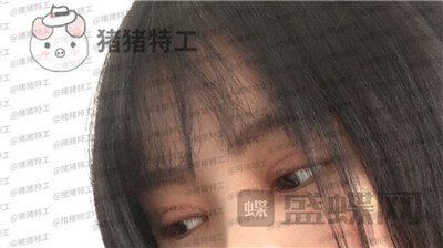 西安高一生,刘军,双眼皮,案例,价格,
