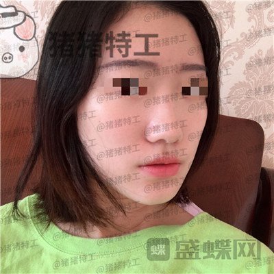 武汉华美,马行,鼻部手术,案例,价格,