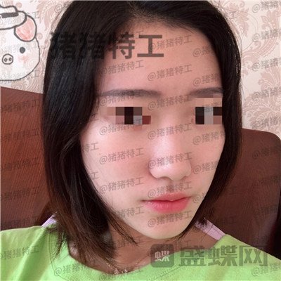 武汉华美,马行,鼻部手术,案例,价格,