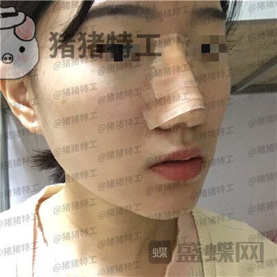 武汉华美,马行,鼻部手术,案例,价格,