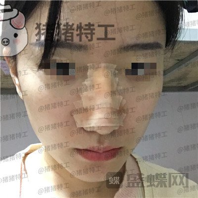 武汉华美,马行,鼻部手术,案例,价格,