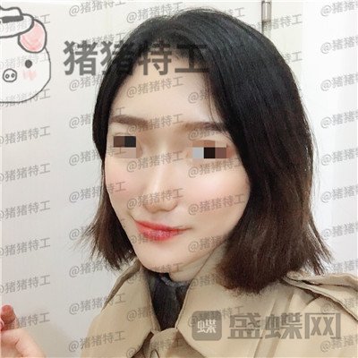 武汉华美,马行,鼻部手术,案例,价格,