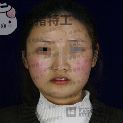 四川友谊,张立天,下颌角,磨骨,案例,价格,