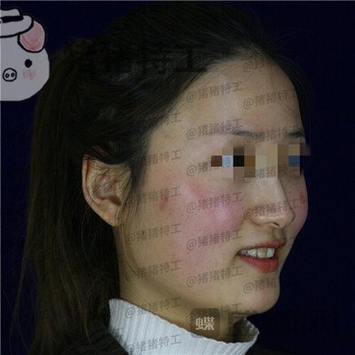 四川友谊,张立天,下颌角,磨骨,案例,价格,