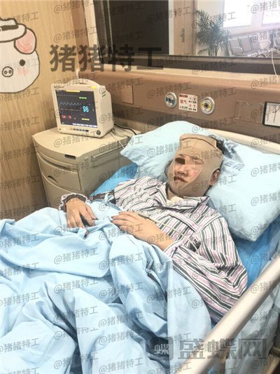 四川友谊,张立天,下颌角,磨骨,案例,价格,