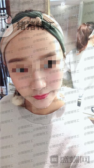四川友谊,张立天,下颌角,磨骨,案例,价格,