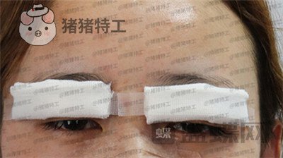 深圳博爱曙光,白云,双眼皮,案例,价格,
