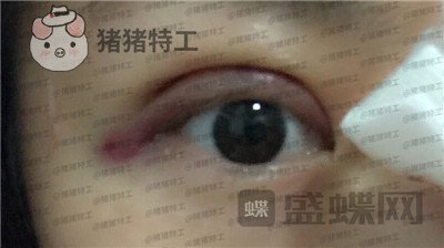 深圳博爱曙光,白云,双眼皮,案例,价格,