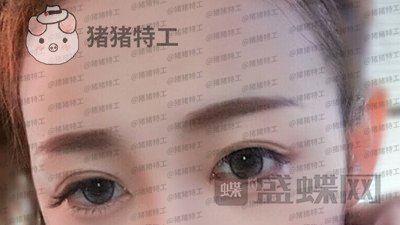 深圳博爱曙光,白云,双眼皮,案例,价格,