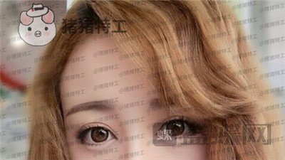 深圳博爱曙光,白云,双眼皮,案例,价格,