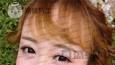 深圳博爱曙光,白云,双眼皮,案例,价格,