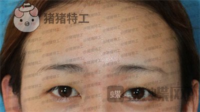 深圳博爱曙光,白云,双眼皮,案例,价格,