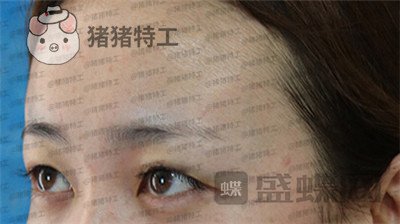 深圳博爱曙光,白云,双眼皮,案例,价格,
