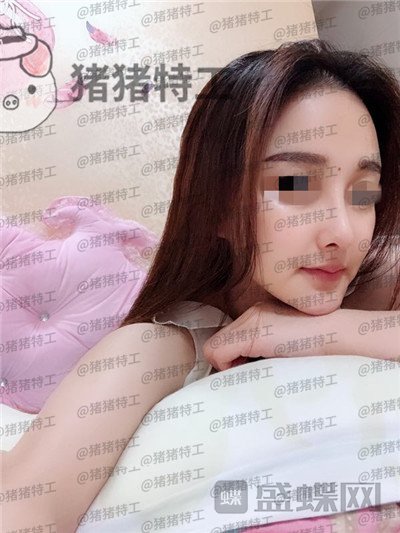 福州爱美尔,张胜利,鼻部手术,案例,价格,