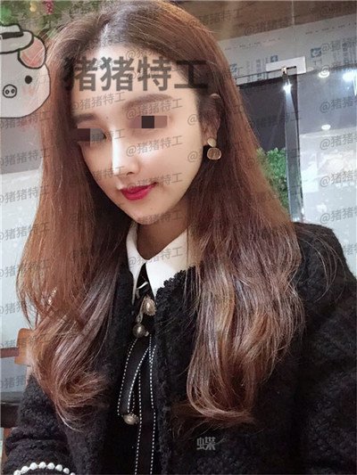 福州爱美尔,张胜利,鼻部手术,案例,价格,