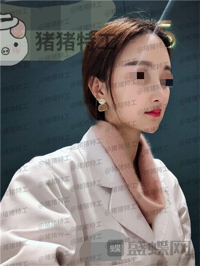 福州爱美尔,张胜利,鼻部手术,案例,价格,