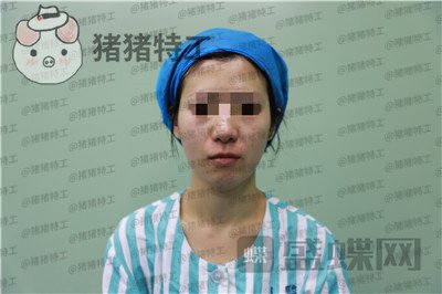 杭州同荣丽格,郭同荣,面部填充,案例,价格,