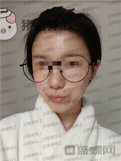 杭州同荣丽格,郭同荣,面部填充,案例,价格,