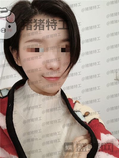 杭州同荣丽格,郭同荣,面部填充,案例,价格,