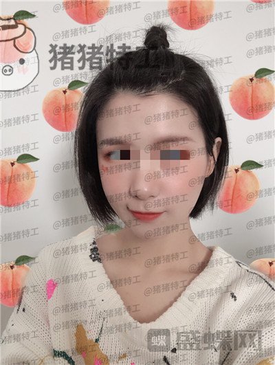杭州同荣丽格,郭同荣,面部填充,案例,价格,