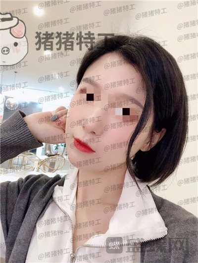 杭州同荣丽格,郭同荣,面部填充,案例,价格,