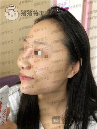 云南华美美莱,洪晓娅,鼻部手术,案例,价格,