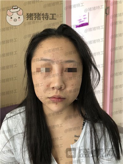 云南华美美莱,洪晓娅,鼻部手术,案例,价格,