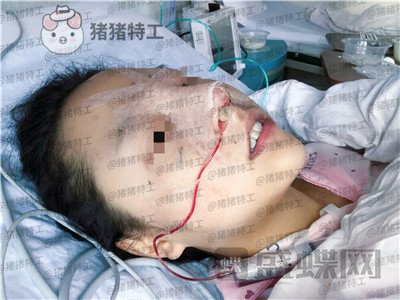 云南华美美莱,洪晓娅,鼻部手术,案例,价格,
