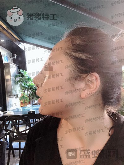 云南华美美莱,洪晓娅,鼻部手术,案例,价格,
