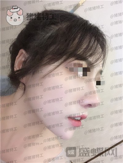 云南华美美莱,洪晓娅,鼻部手术,案例,价格,