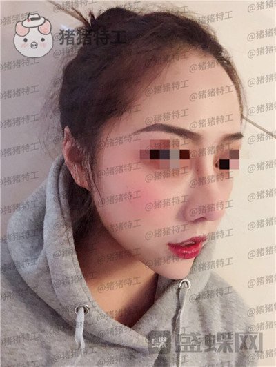 云南华美美莱,洪晓娅,鼻部手术,案例,价格,