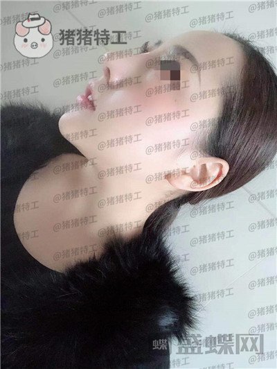 云南华美美莱,洪晓娅,鼻部手术,案例,价格,