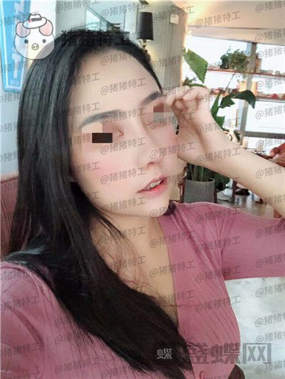 云南华美美莱,洪晓娅,鼻部手术,案例,价格,
