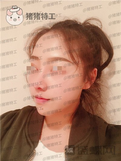 云南华美美莱,洪晓娅,鼻部手术,案例,价格,