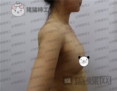 北京英煌,项力源,隆胸,案例,价格,
