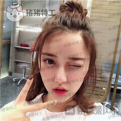 杭州伊琳,毛琪,面部填充,案例,价格,