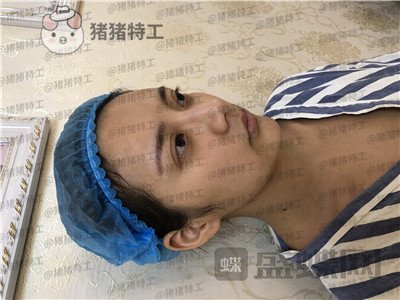 杭州伊琳,毛琪,面部填充,案例,价格,